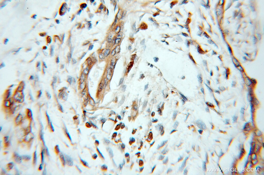 Immunohistochemistry (IHC) staining of human pancreas cancer tissue using ZNF395 Polyclonal antibody (11759-1-AP)