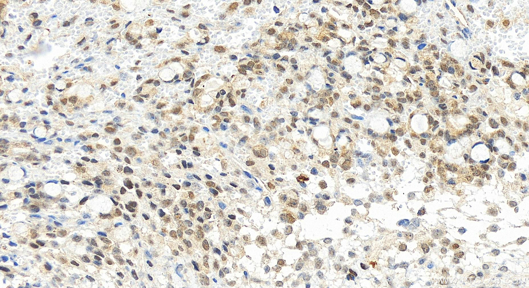 Immunohistochemistry (IHC) staining of human ovary cancer tissue using ZNF511 Polyclonal antibody (20934-1-AP)