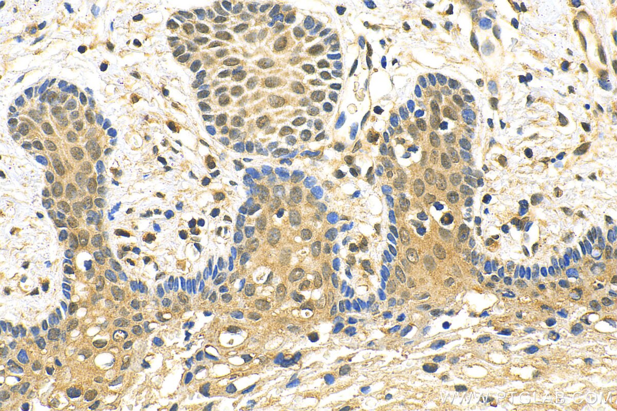 Immunohistochemistry (IHC) staining of human cervical cancer tissue using ZNF618 Polyclonal antibody (31972-1-AP)