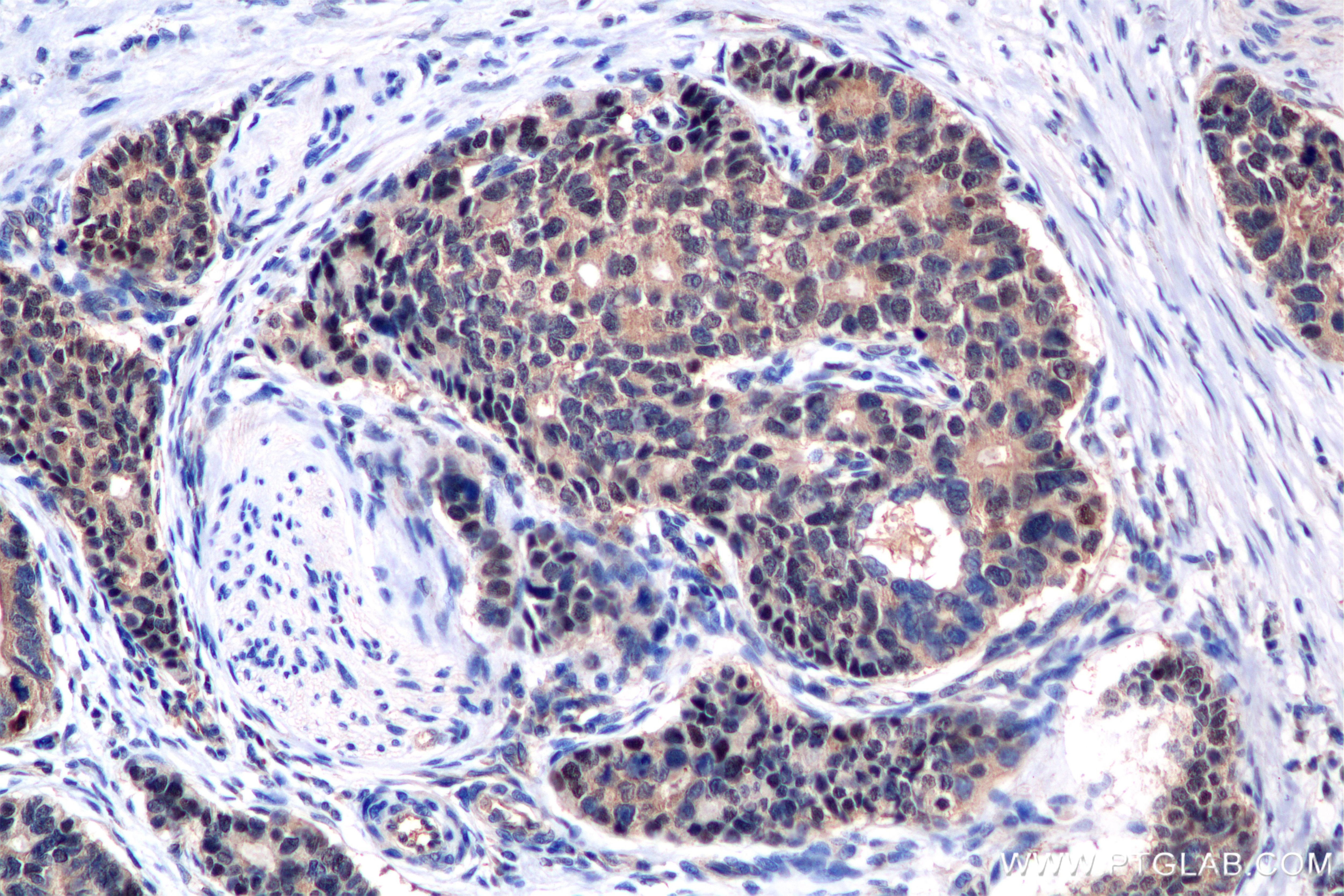 Immunohistochemistry (IHC) staining of human stomach cancer tissue using ZNF618 Recombinant antibody (84998-1-RR)