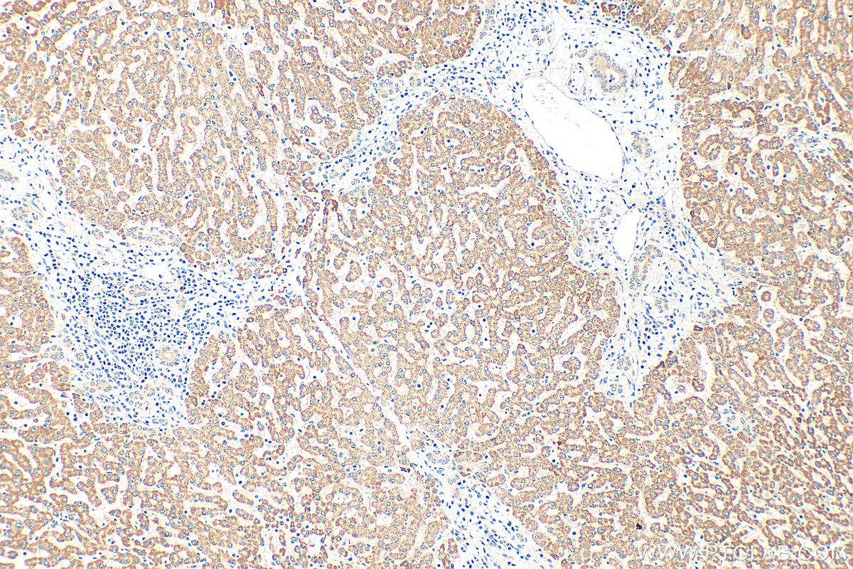 Immunohistochemistry (IHC) staining of human hepatocirrhosis tissue using ZNF622 Polyclonal antibody (20804-1-AP)