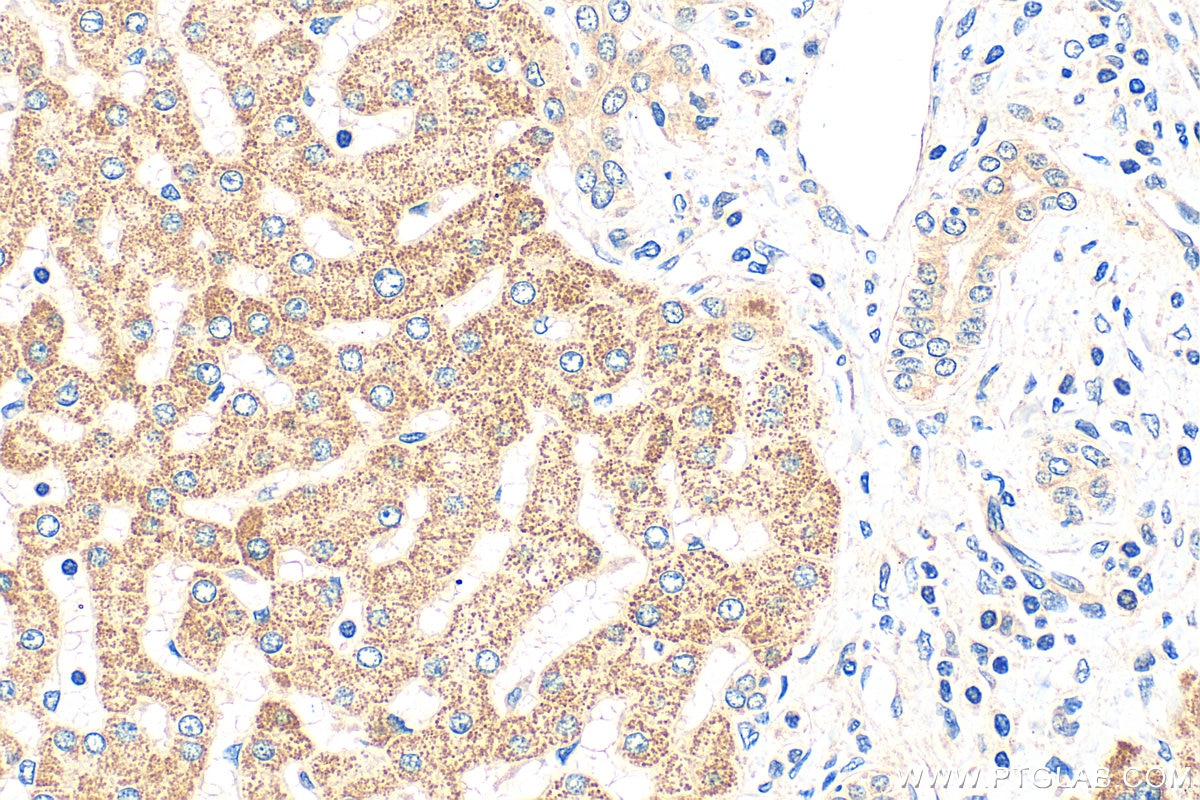 Immunohistochemistry (IHC) staining of human hepatocirrhosis tissue using ZNF622 Polyclonal antibody (20804-1-AP)