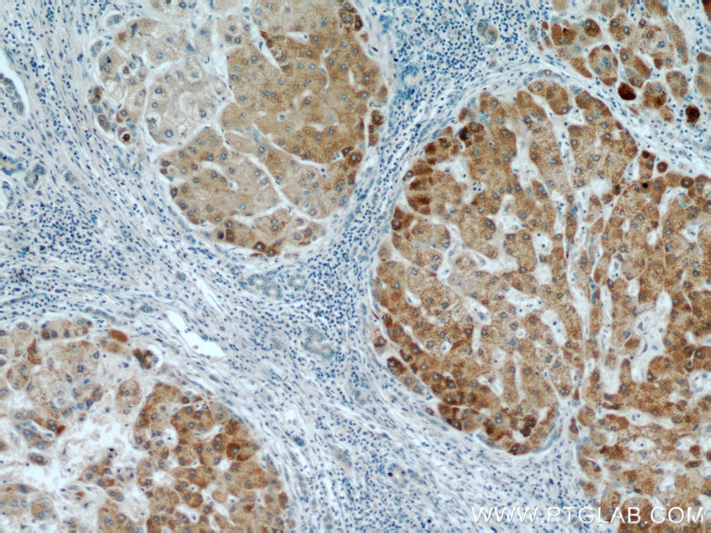Immunohistochemistry (IHC) staining of human hepatocirrhosis tissue using ZNF622 Polyclonal antibody (20804-1-AP)