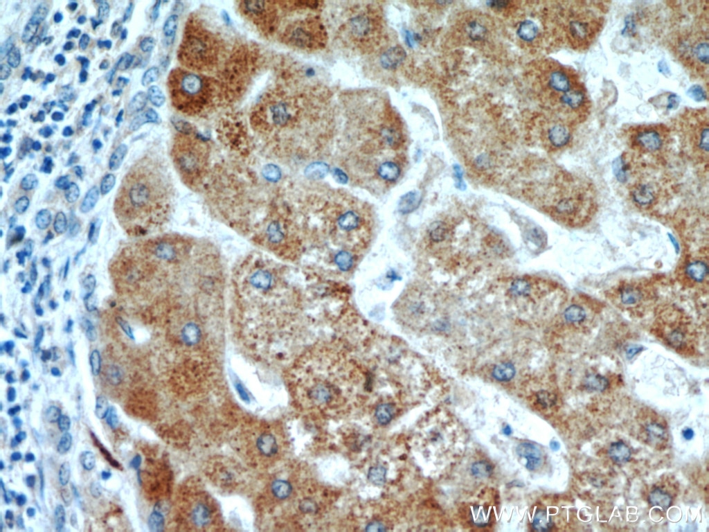Immunohistochemistry (IHC) staining of human hepatocirrhosis tissue using ZNF622 Polyclonal antibody (20804-1-AP)