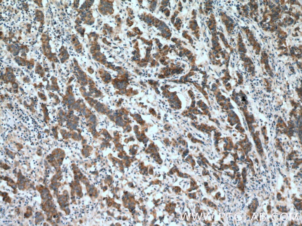 Immunohistochemistry (IHC) staining of human prostate cancer tissue using ZNF645 Polyclonal antibody (25600-1-AP)