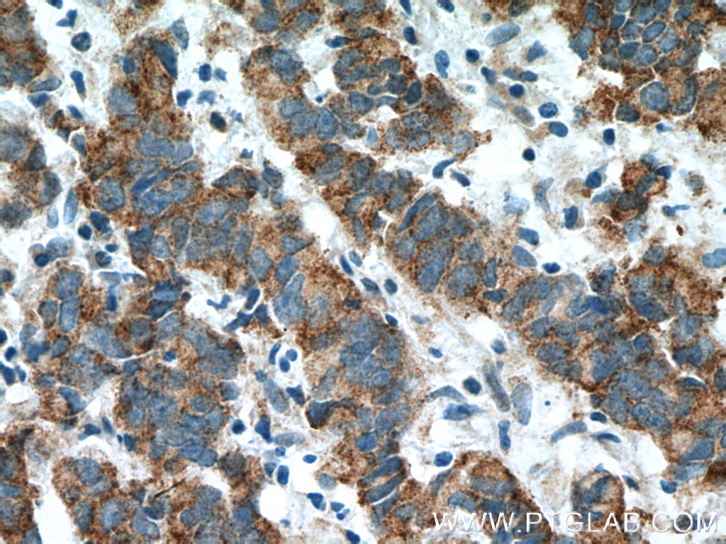 Immunohistochemistry (IHC) staining of human prostate cancer tissue using ZNF645 Polyclonal antibody (25600-1-AP)