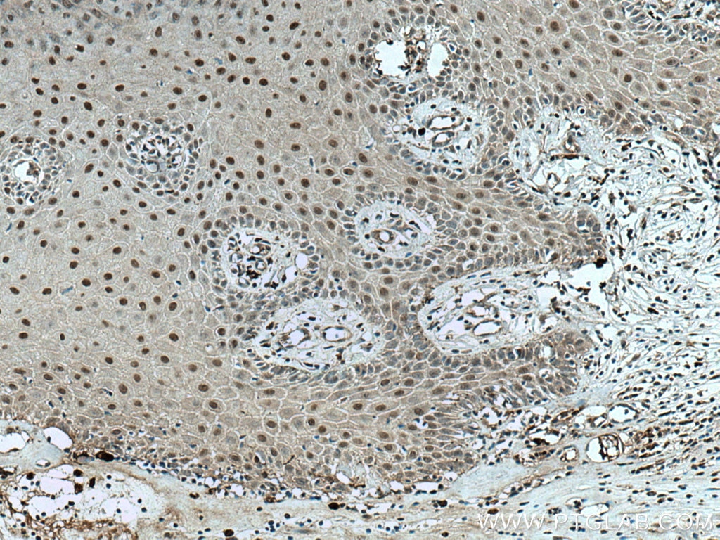 Immunohistochemistry (IHC) staining of human skin cancer tissue using ZNF750 Polyclonal antibody (21752-1-AP)