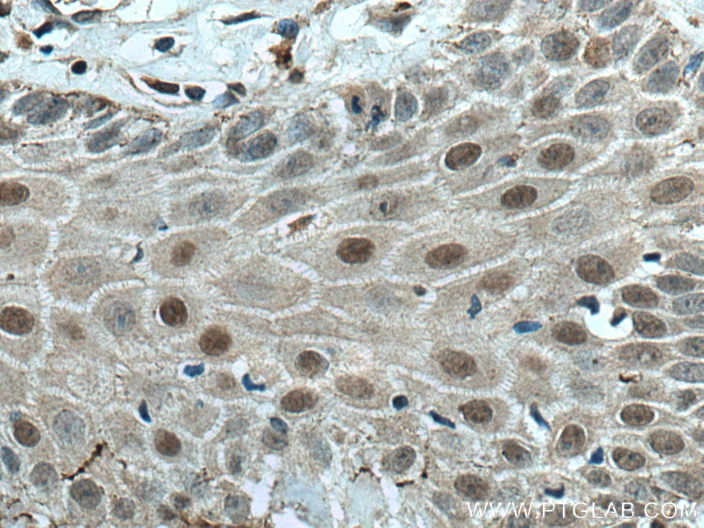 Immunohistochemistry (IHC) staining of human skin cancer tissue using ZNF750 Polyclonal antibody (21752-1-AP)