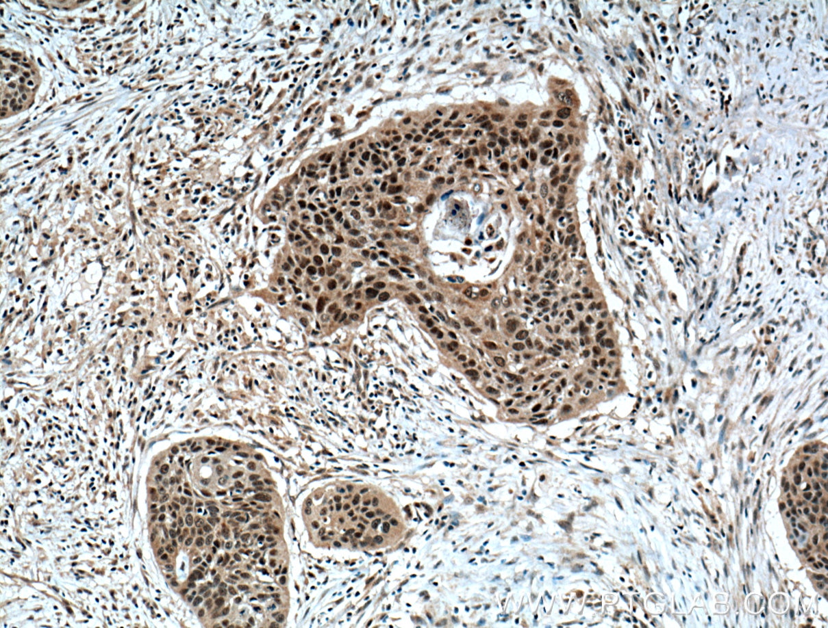 Immunohistochemistry (IHC) staining of human oesophagus cancer tissue using ZNF750 Polyclonal antibody (21752-1-AP)