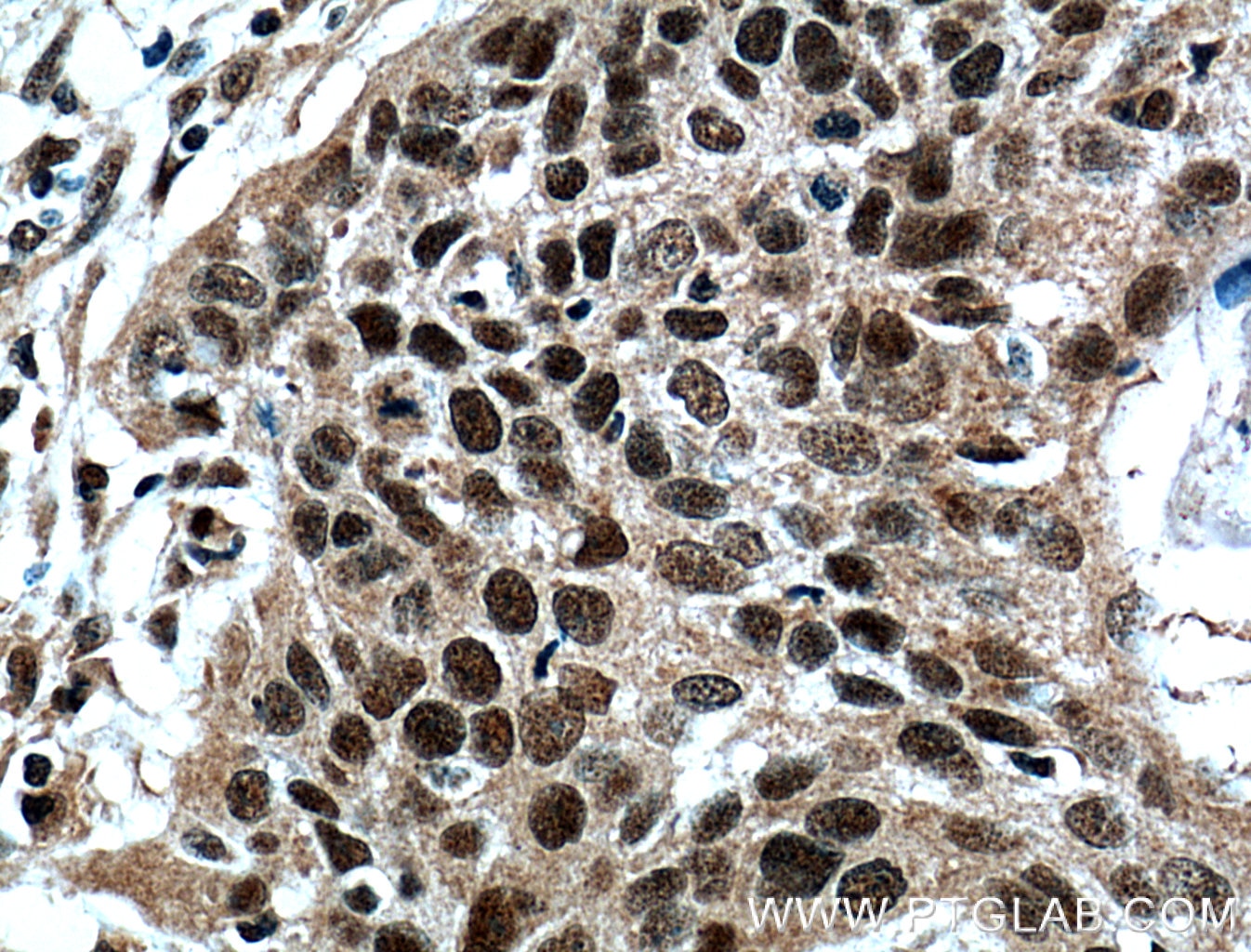 Immunohistochemistry (IHC) staining of human oesophagus cancer tissue using ZNF750 Polyclonal antibody (21752-1-AP)
