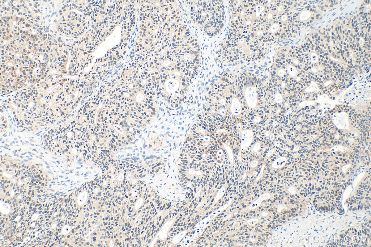 Immunohistochemistry (IHC) staining of human ovary tumor tissue using ZNF816 Polyclonal antibody (21221-1-AP)