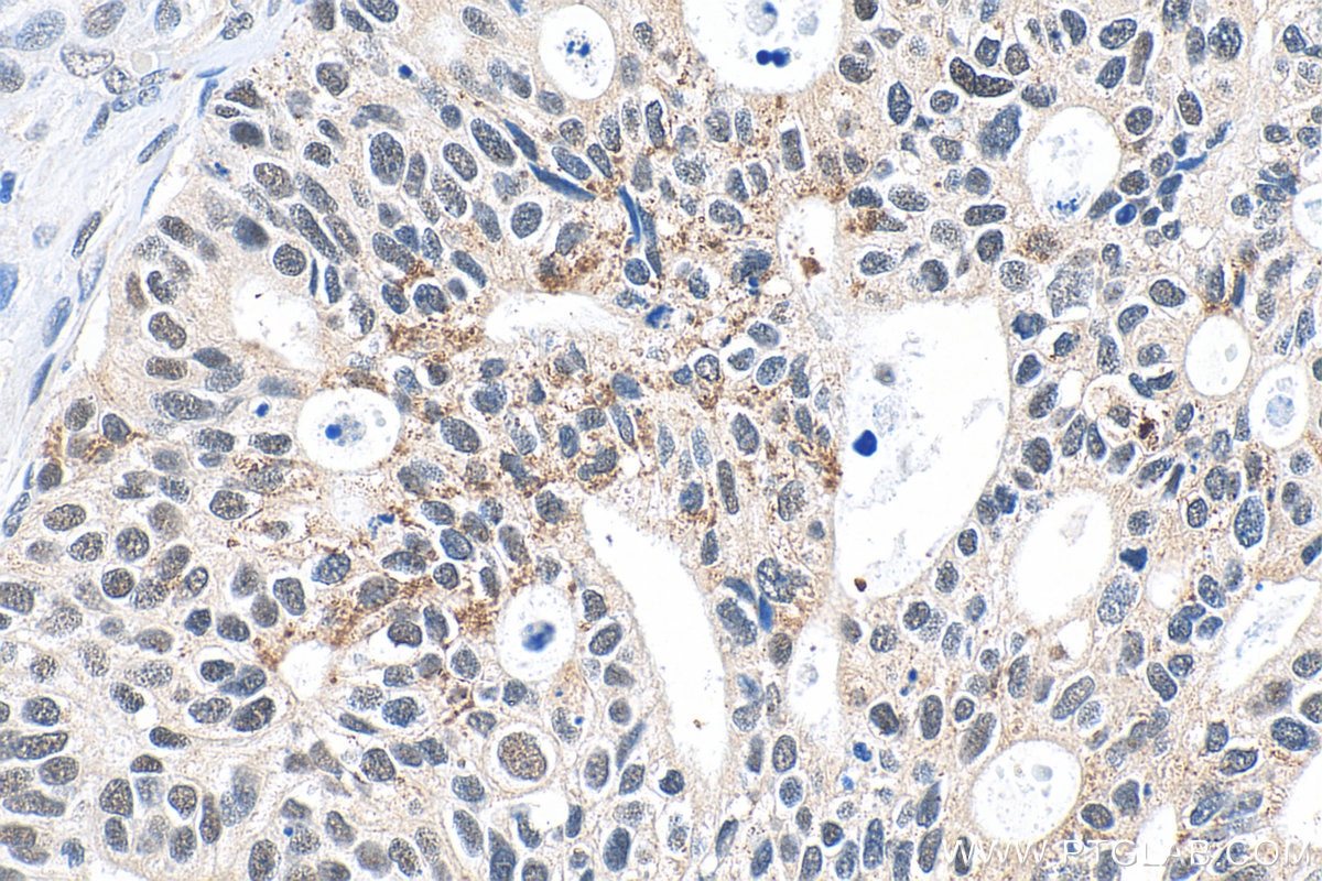 Immunohistochemistry (IHC) staining of human ovary tumor tissue using ZNF816 Polyclonal antibody (21221-1-AP)