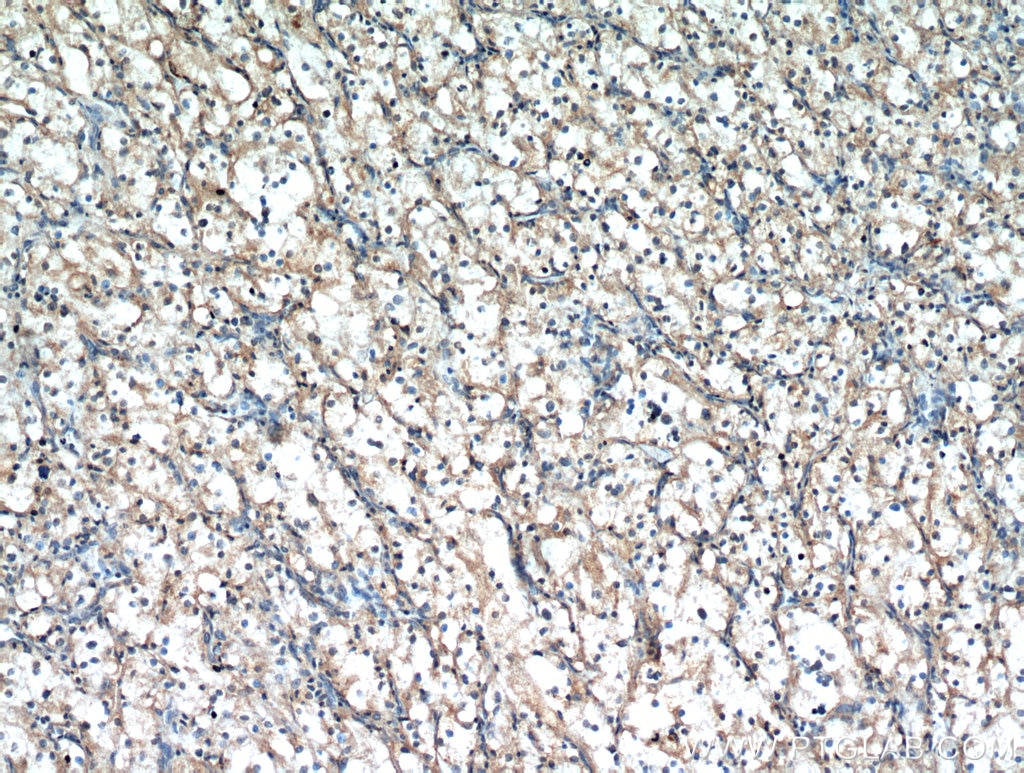 Immunohistochemistry (IHC) staining of human renal cell carcinoma tissue using ZNF839 Polyclonal antibody (20539-1-AP)