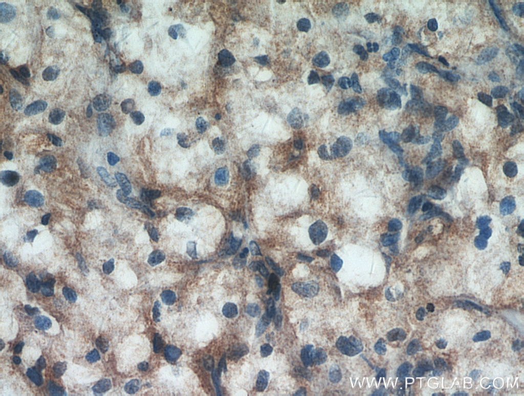 Immunohistochemistry (IHC) staining of human renal cell carcinoma tissue using ZNF839 Polyclonal antibody (20539-1-AP)