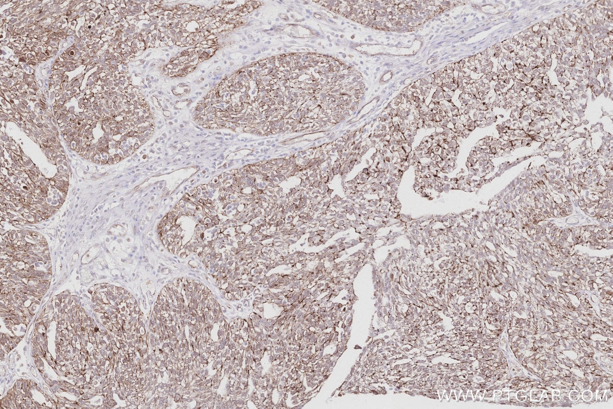 IHC staining of human ovary cancer using 83111-4-RR (same clone as 83111-4-PBS) Immunohistochemistry (IHC) staining of human ovary cancer tissue using ZO-2 Recombinant monoclonal antibody (83111-4-RR)