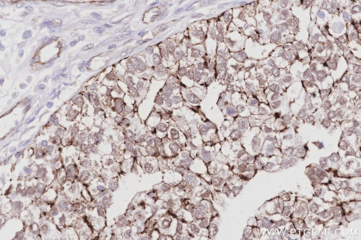 IHC staining of human ovary cancer using 83111-4-RR Immunohistochemistry (IHC) staining of human ovary cancer tissue using ZO-2 Recombinant monoclonal antibody (83111-4-RR)