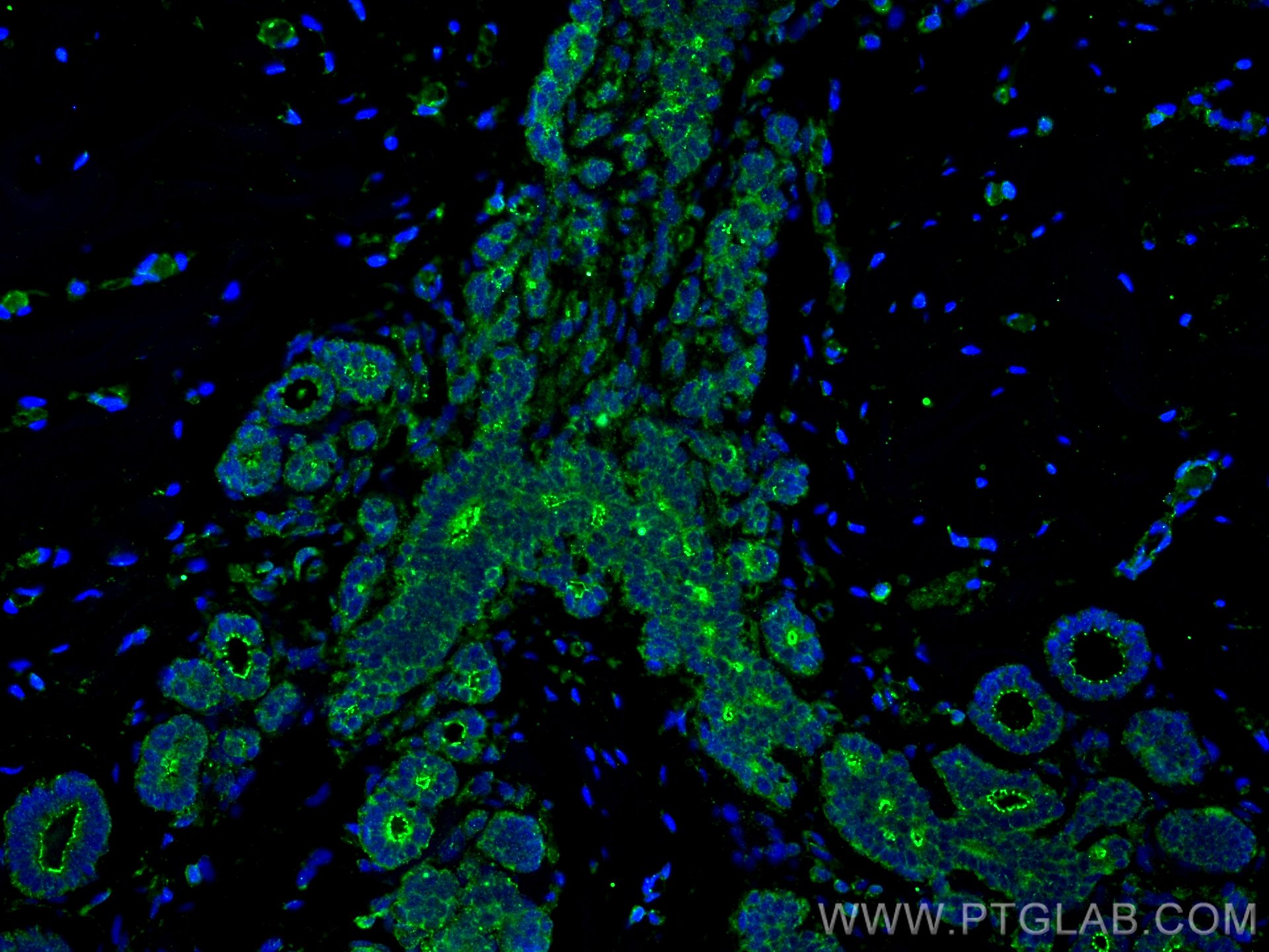 Immunofluorescence (IF) / fluorescent staining of human breast cancer tissue using ZO-1 Polyclonal antibody (21773-1-AP)
