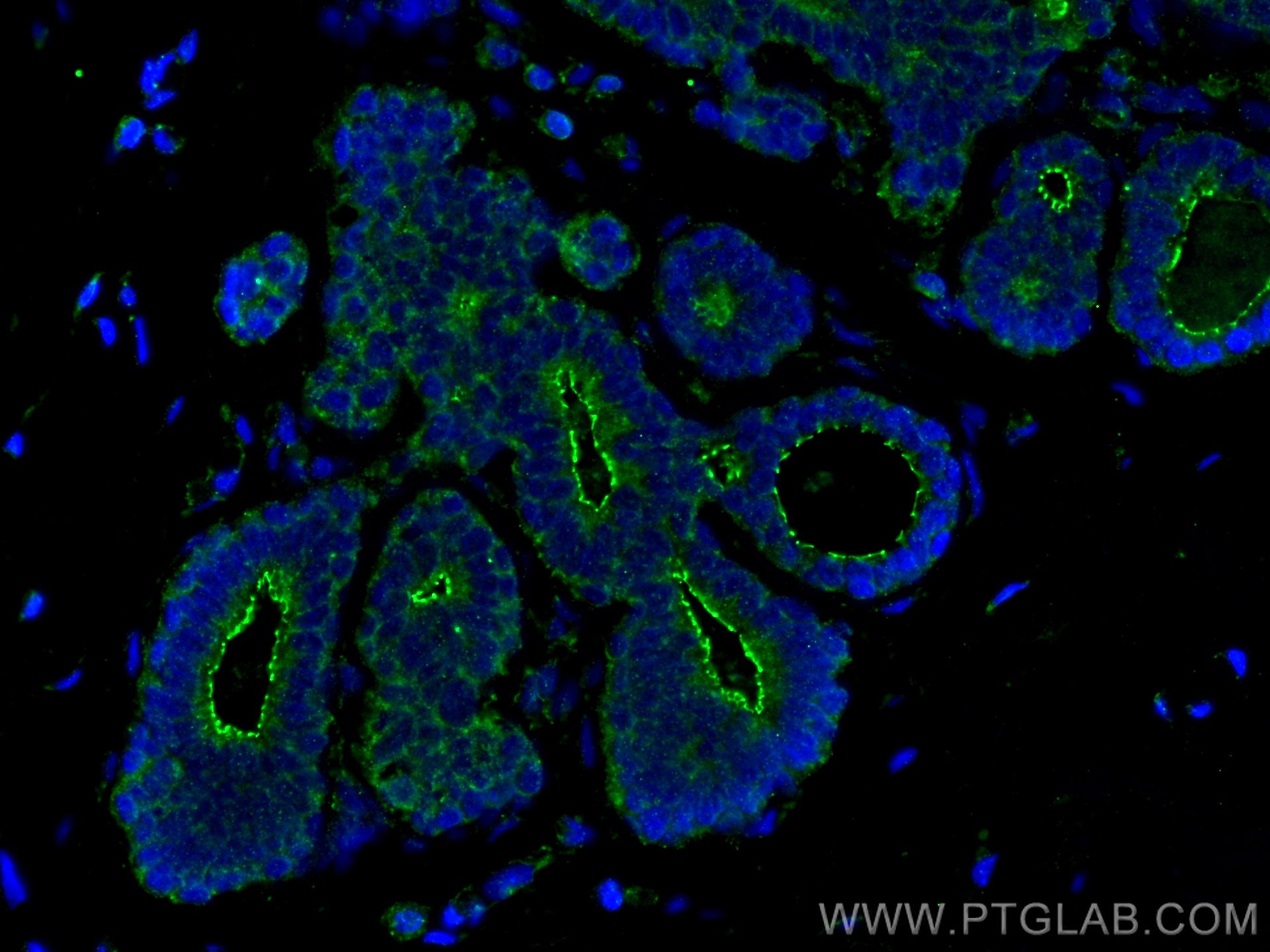 Immunofluorescence (IF) / fluorescent staining of human breast cancer tissue using ZO-1 Polyclonal antibody (21773-1-AP)
