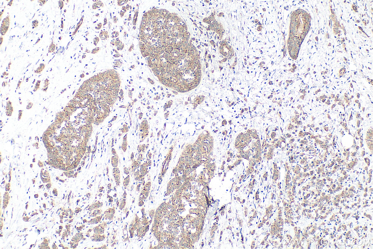 IHC staining of human breast cancer using 21773-1-AP Immunohistochemistry (IHC) staining of human breast cancer tissue using ZO-1 Polyclonal antibody (21773-1-AP)