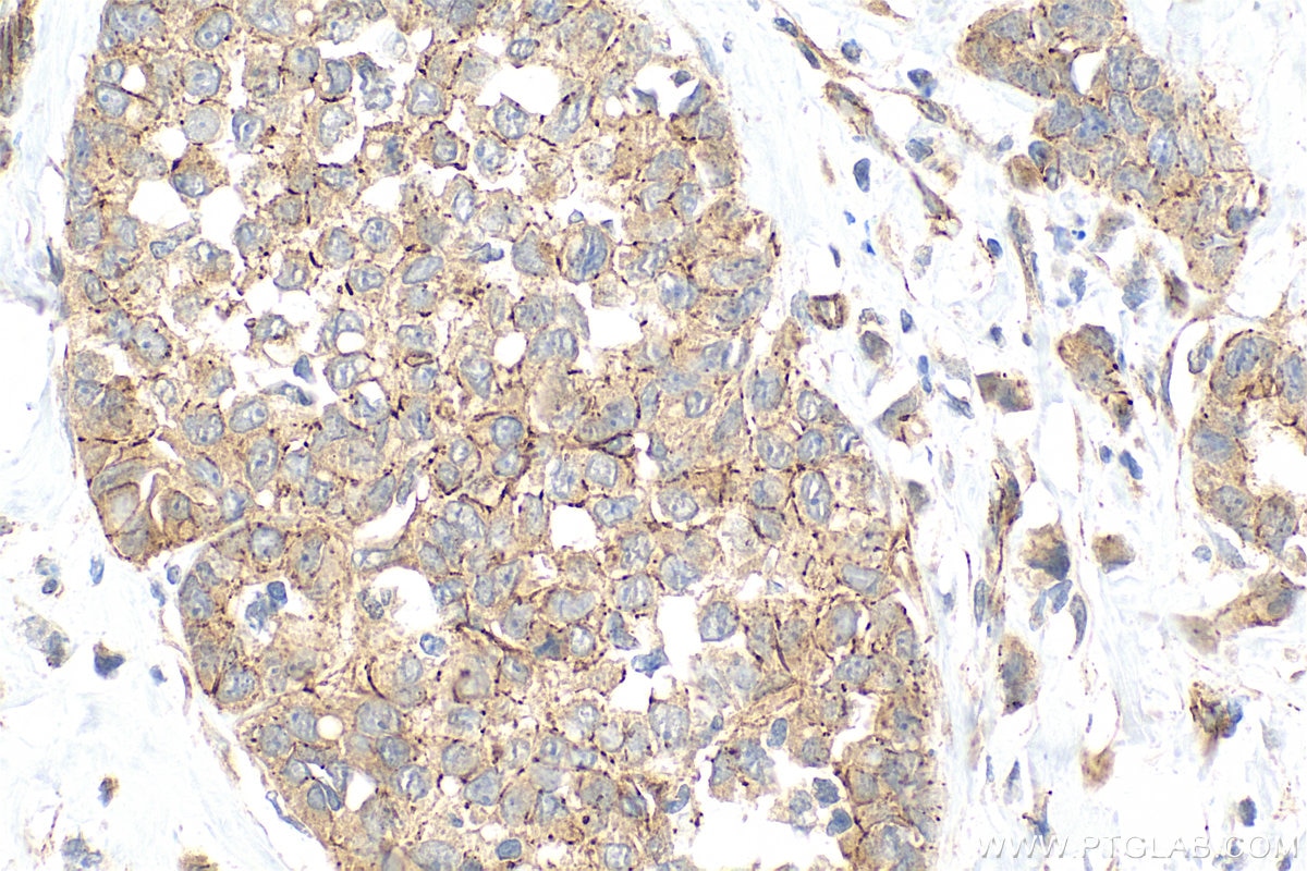 IHC staining of human breast cancer using 21773-1-AP Immunohistochemistry (IHC) staining of human breast cancer tissue using ZO-1 Polyclonal antibody (21773-1-AP)