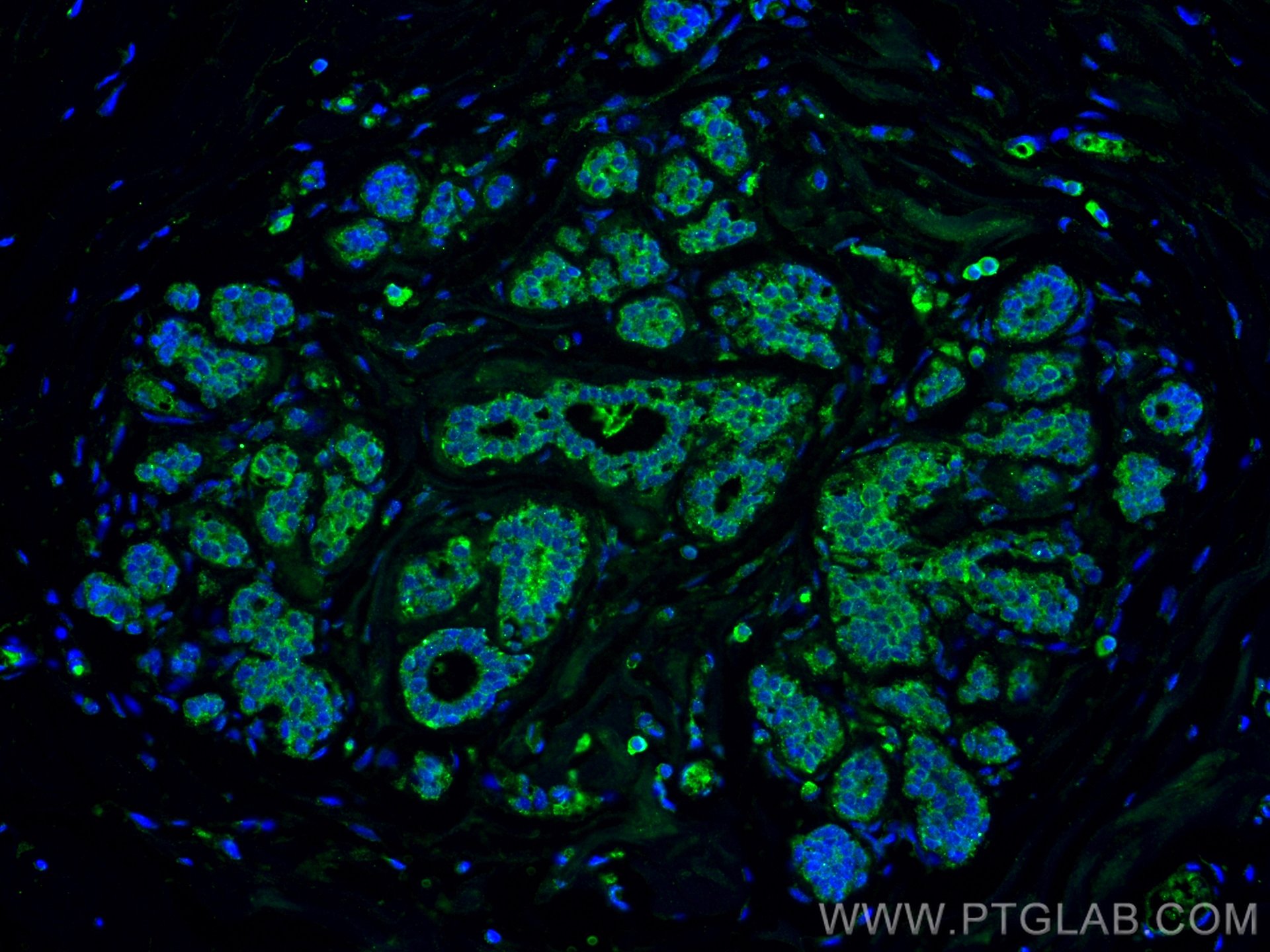 Immunofluorescence (IF) / fluorescent staining of human breast cancer tissue using ZO-1 Monoclonal antibody (66452-1-Ig)