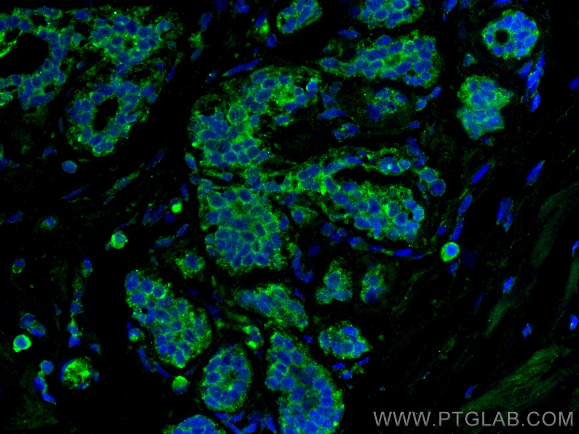 Immunofluorescence (IF) / fluorescent staining of human breast cancer tissue using ZO-1 Monoclonal antibody (66452-1-Ig)