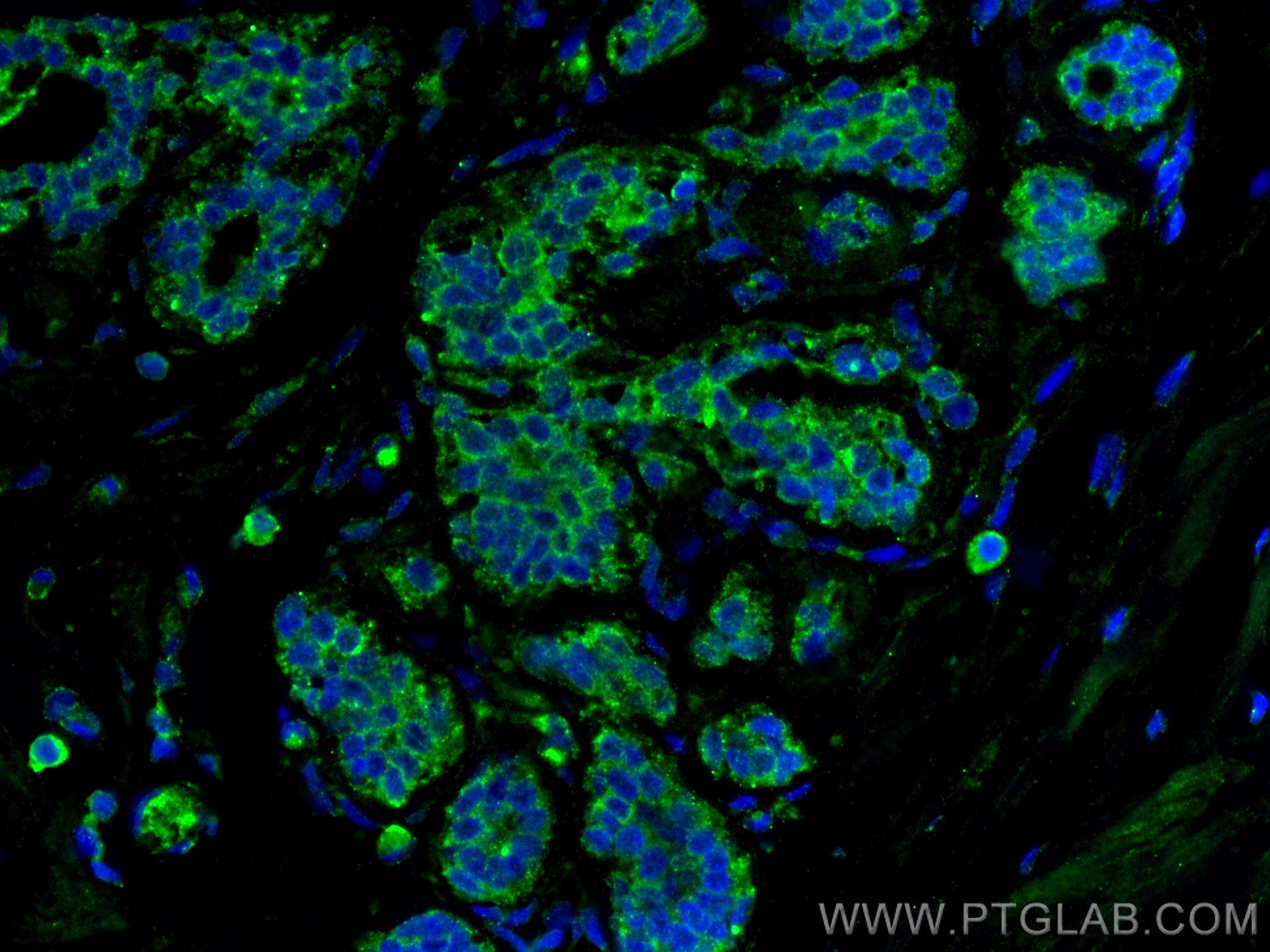 IF Staining of human breast cancer using 66452-1-Ig