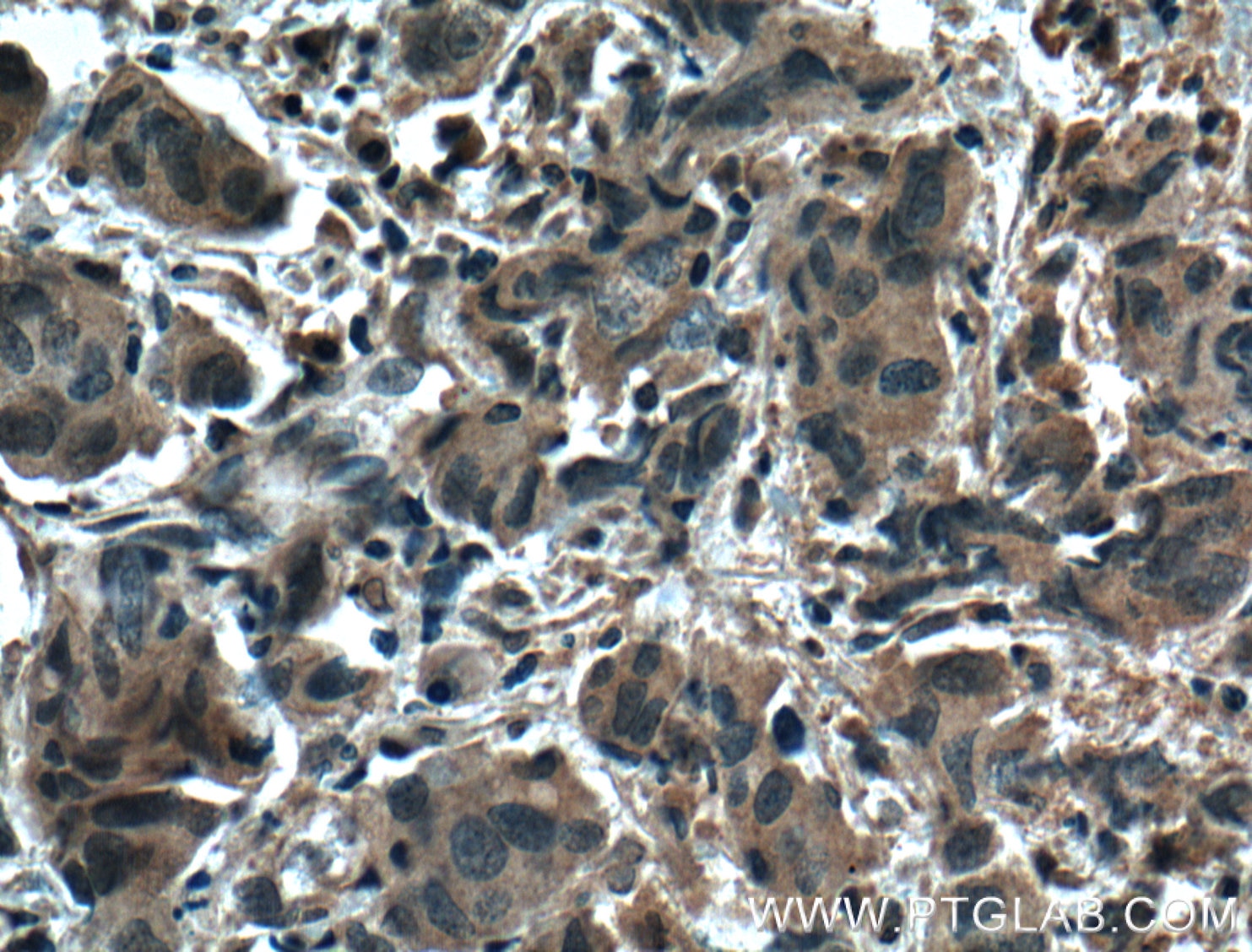 Immunohistochemistry (IHC) staining of human prostate cancer tissue using ZO-1 Monoclonal antibody (66452-1-Ig)