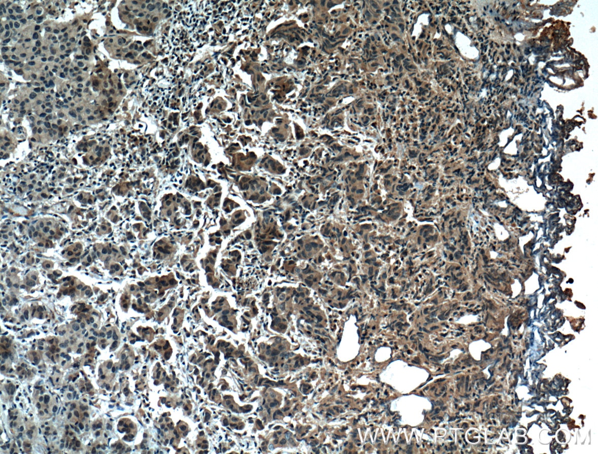 Immunohistochemistry (IHC) staining of human prostate cancer tissue using ZO-1 Monoclonal antibody (66452-1-Ig)