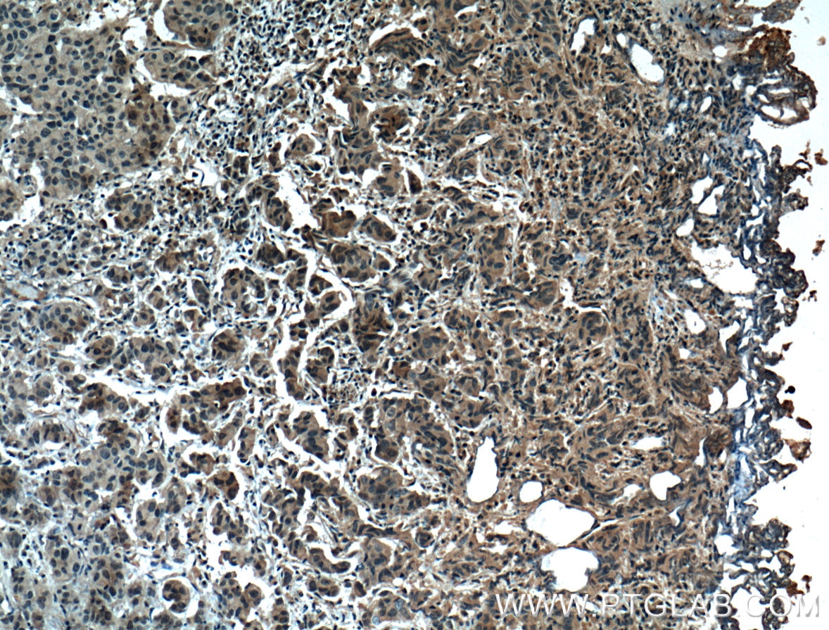 IHC staining of human prostate cancer using 66452-1-Ig