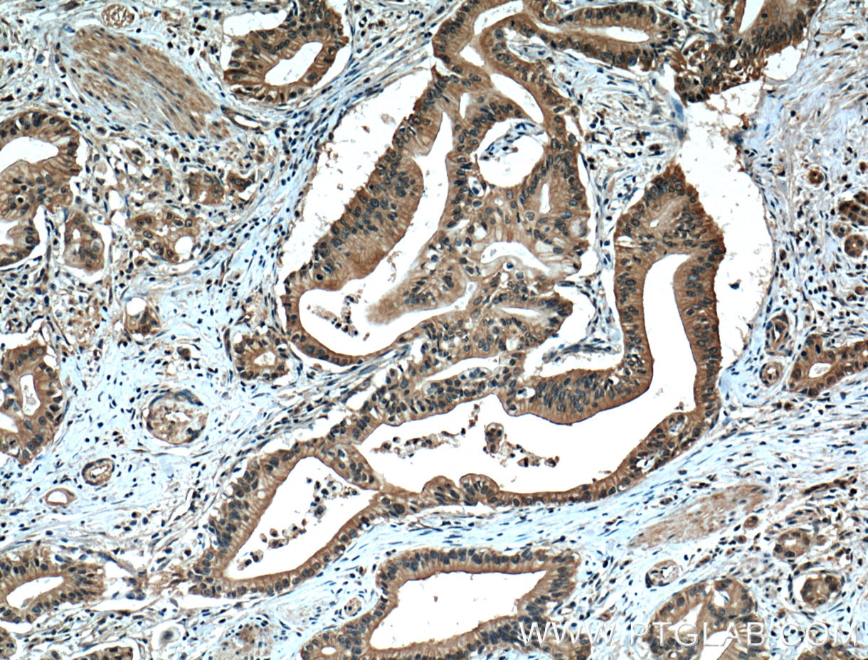 Immunohistochemistry (IHC) staining of human pancreas cancer tissue using ZO-1 Monoclonal antibody (66452-1-Ig)