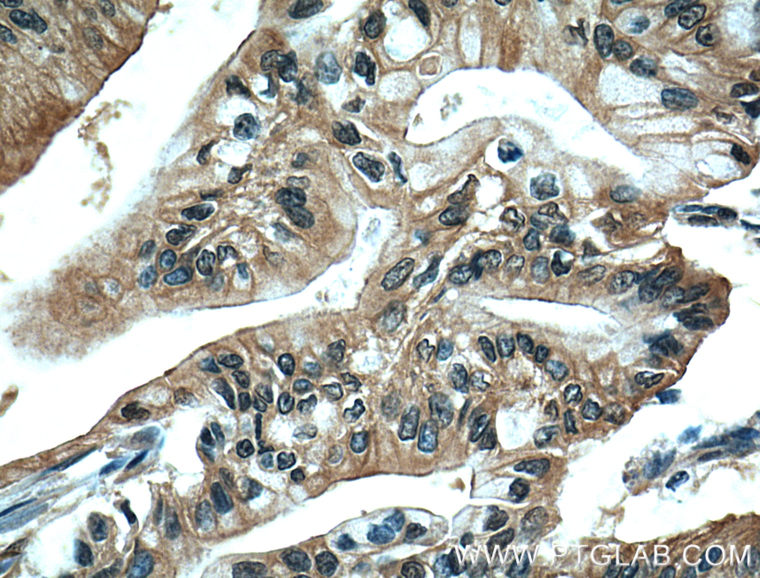 Immunohistochemistry (IHC) staining of human pancreas cancer tissue using ZO-1 Monoclonal antibody (66452-1-Ig)
