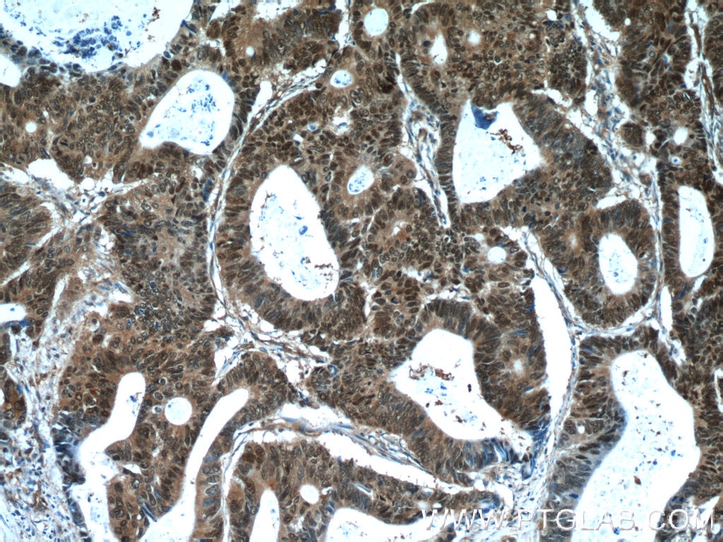 IHC staining of human colon cancer using 14281-1-AP
