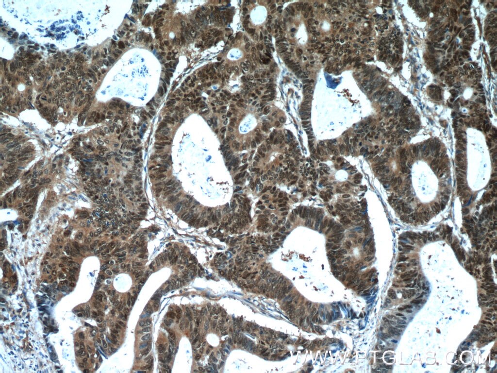 Immunohistochemistry (IHC) staining of human colon cancer tissue using ZWILCH Polyclonal antibody (14281-1-AP)