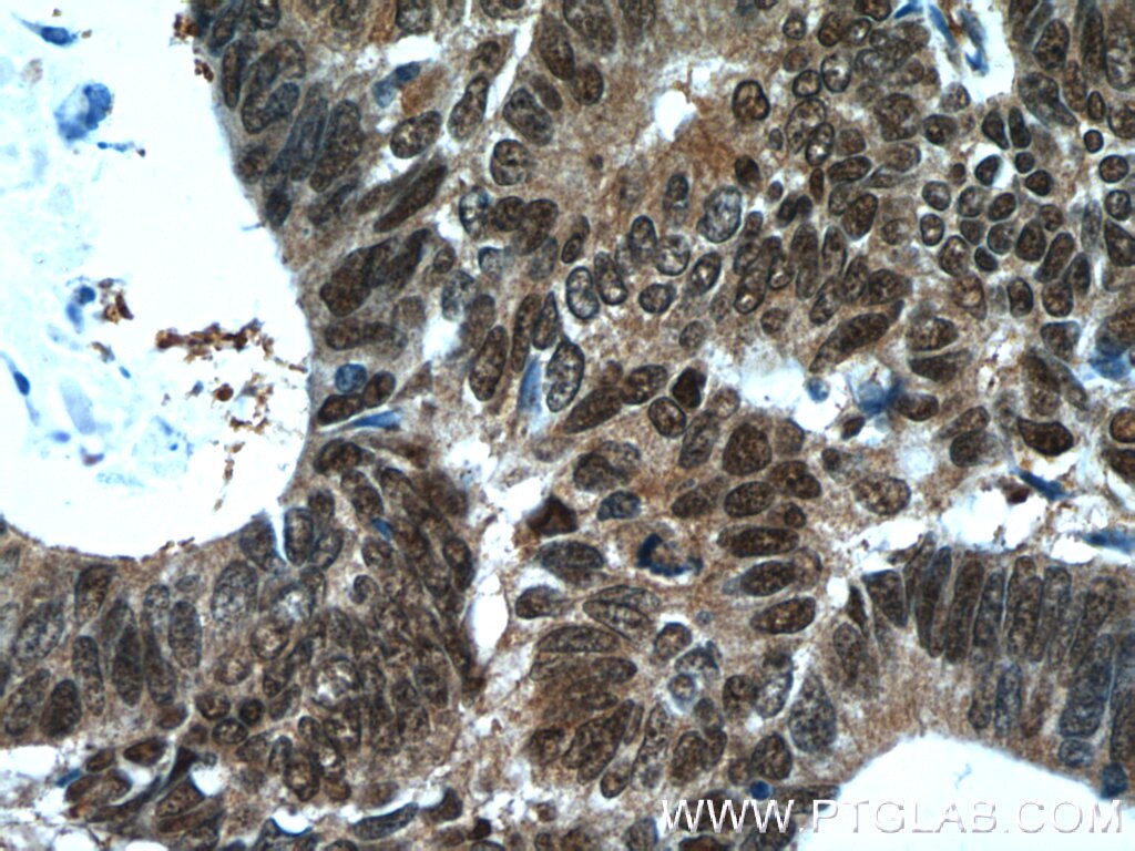 Immunohistochemistry (IHC) staining of human colon cancer tissue using ZWILCH Polyclonal antibody (14281-1-AP)