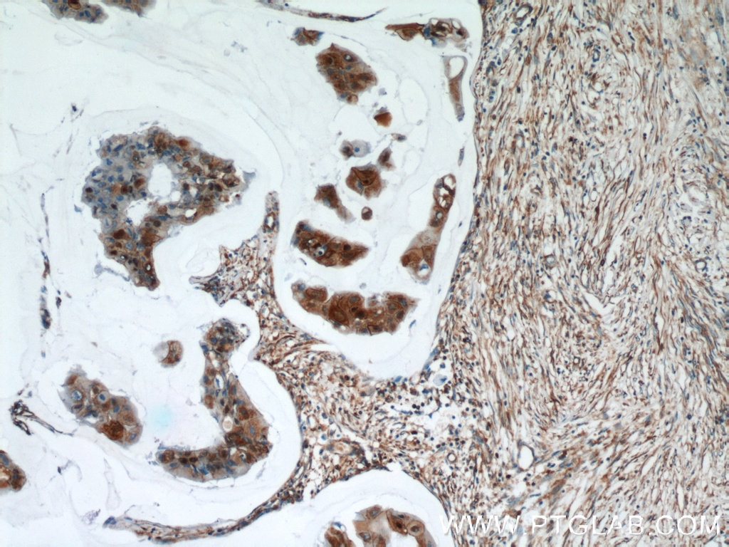 IHC staining of human breast cancer using 60254-1-Ig