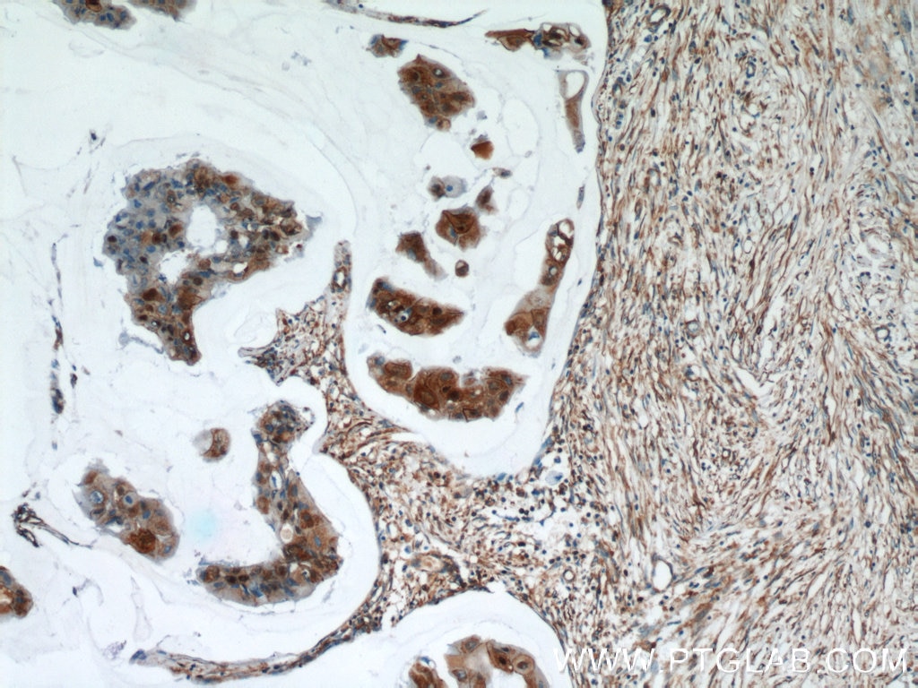 Immunohistochemistry (IHC) staining of human breast cancer tissue using Zyxin Monoclonal antibody (60254-1-Ig)