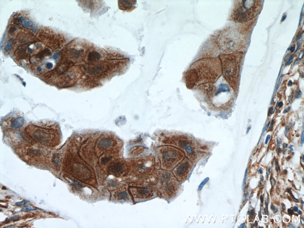 Immunohistochemistry (IHC) staining of human breast cancer tissue using Zyxin Monoclonal antibody (60254-1-Ig)
