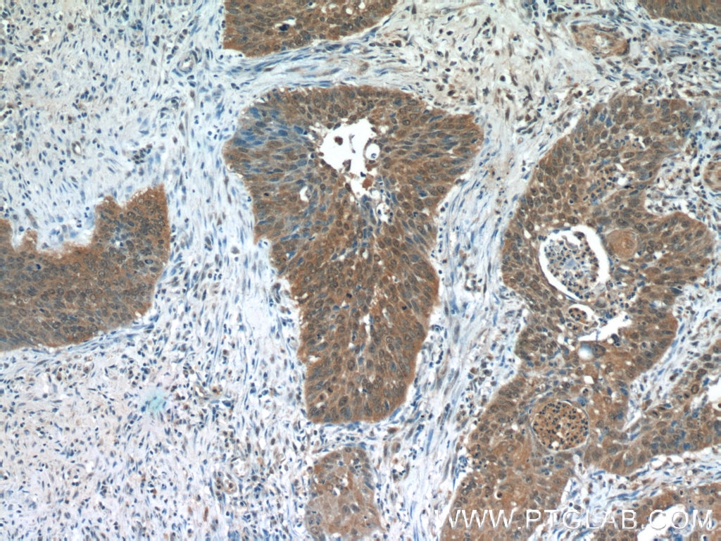 Immunohistochemistry (IHC) staining of human cervical cancer tissue using Zyxin Monoclonal antibody (60254-1-Ig)