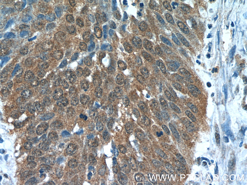 Immunohistochemistry (IHC) staining of human cervical cancer tissue using Zyxin Monoclonal antibody (60254-1-Ig)
