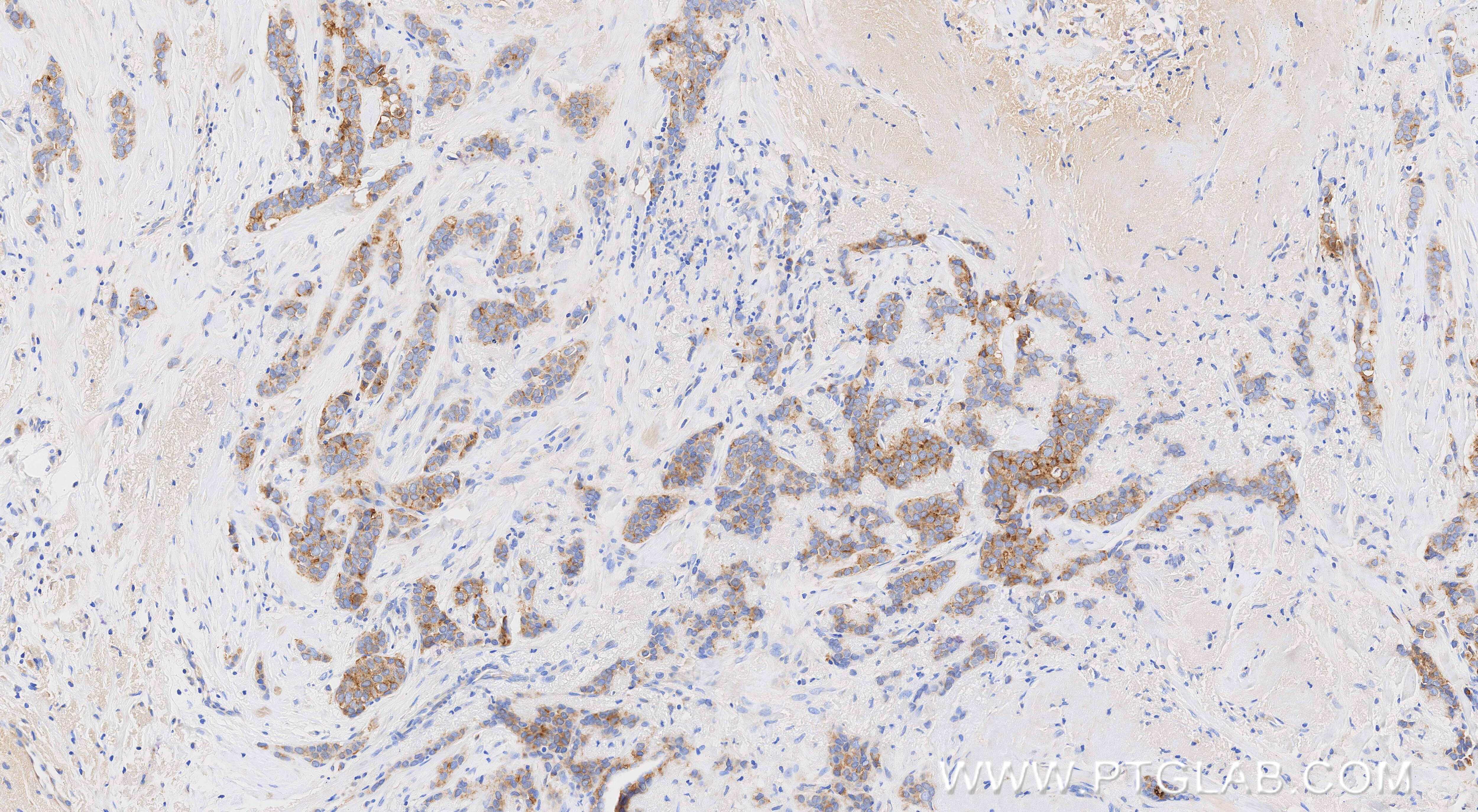 Immunohistochemistry (IHC) staining of human breast cancer tissue using Zinc Alpha 2 Glycoprotein Recombinant monoclonal a (86781-3-RR)