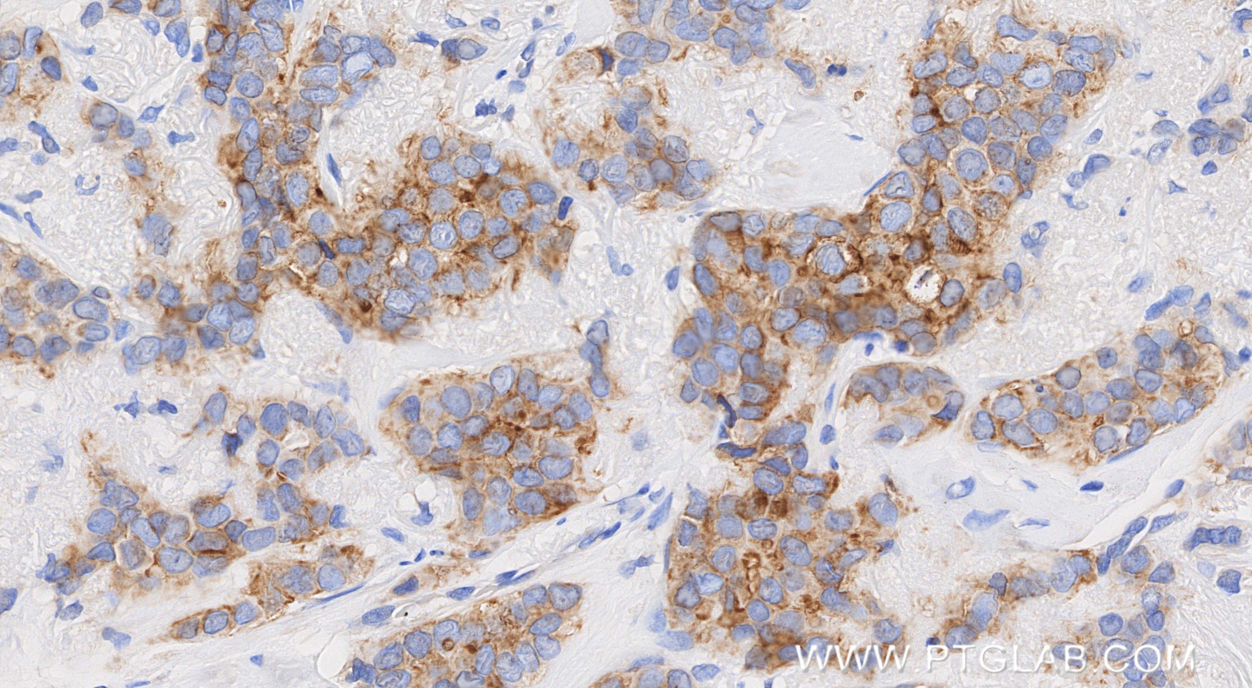 Immunohistochemistry (IHC) staining of human breast cancer tissue using Zinc Alpha 2 Glycoprotein Recombinant monoclonal a (86781-3-RR)