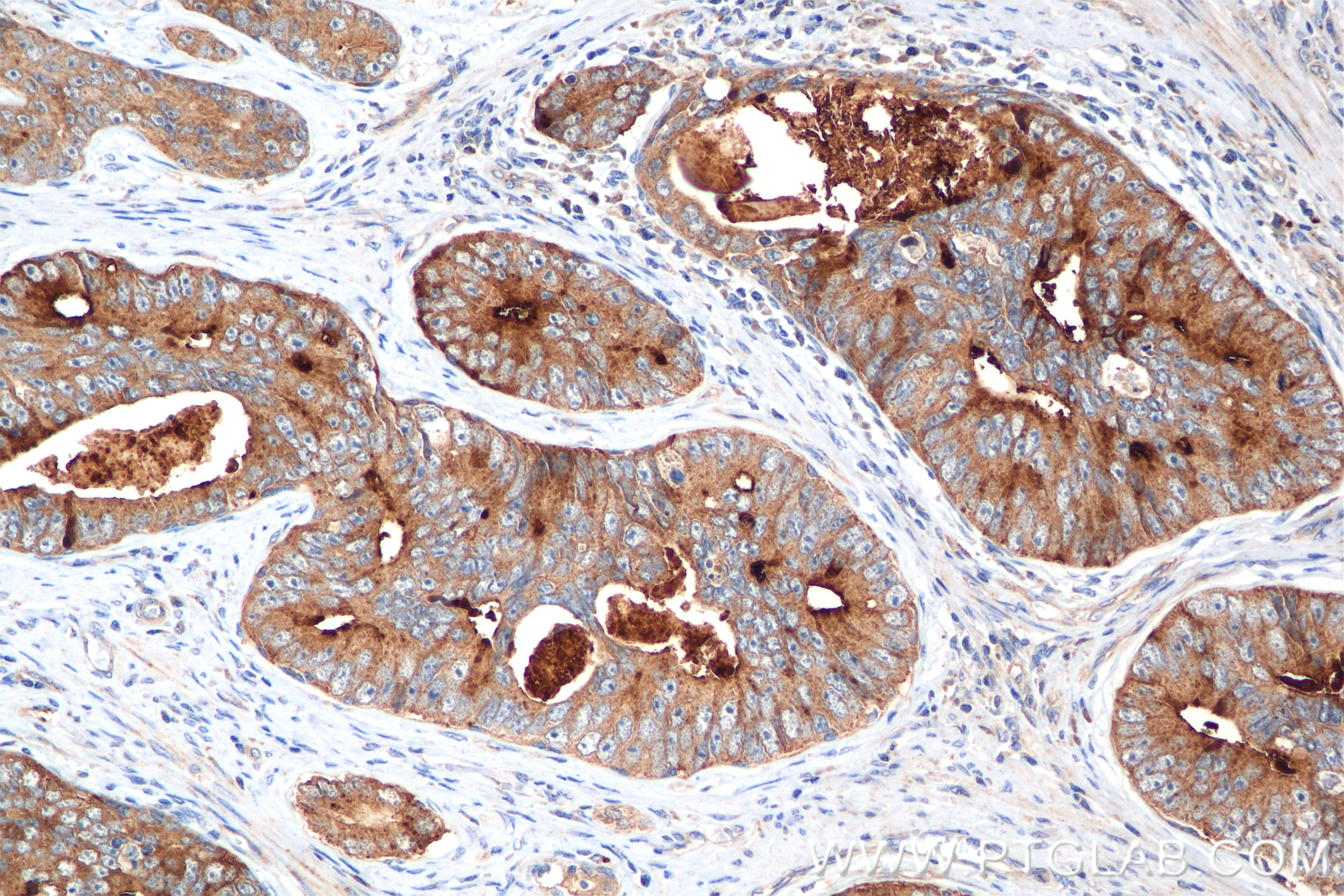 Immunohistochemistry (IHC) staining of human prostate cancer tissue using ZnT4 Recombinant antibody (86336-1-RR)