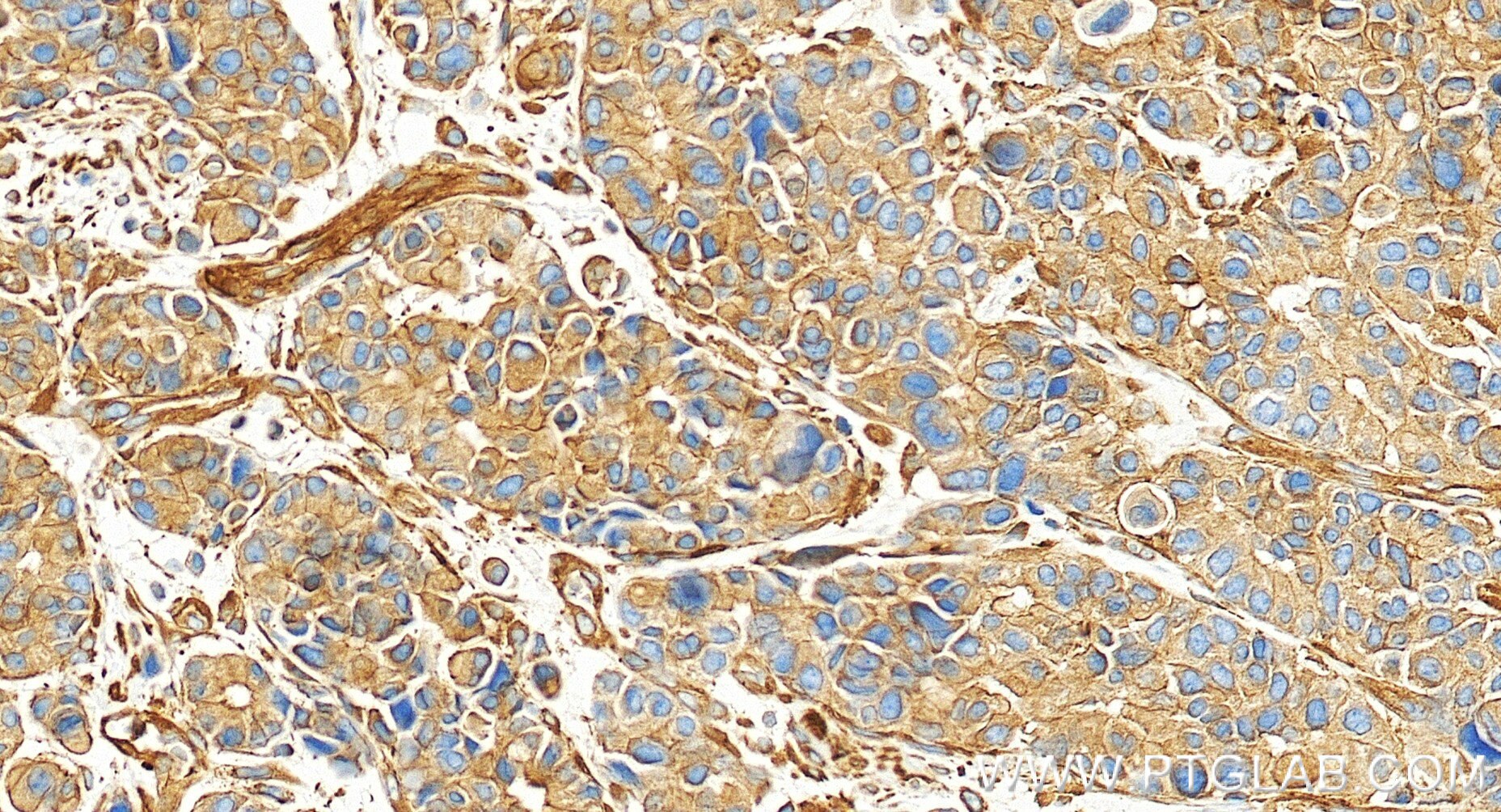 Immunohistochemistry (IHC) staining of human stomach cancer tissue using Zyxin Recombinant monoclonal antibody (86364-3-RR)