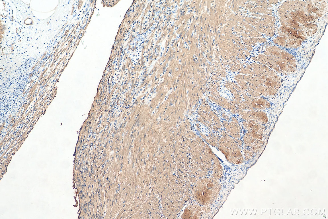 Immunohistochemistry (IHC) staining of human appendicitis tissue using smooth muscle actin specific Recombinant antibody (80008-1-RR)
