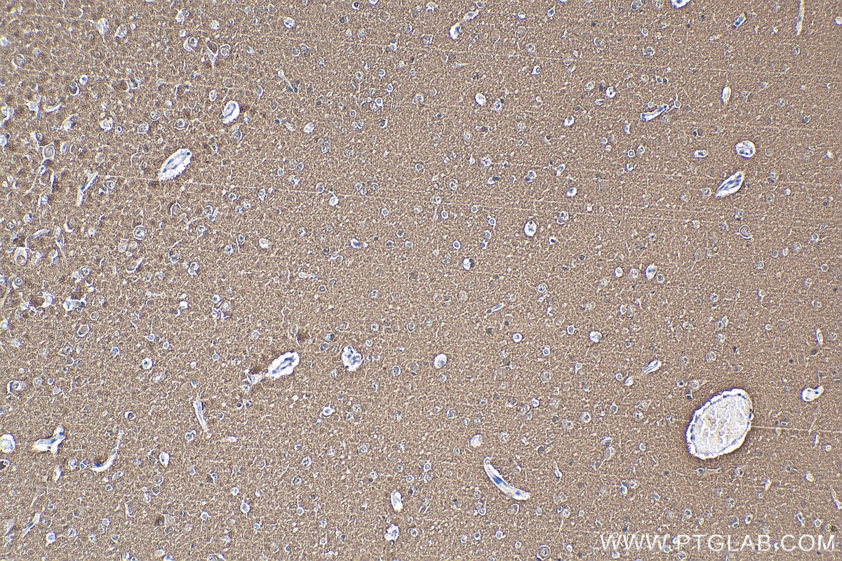 IHC staining of human gliomas using 66412-1-Ig