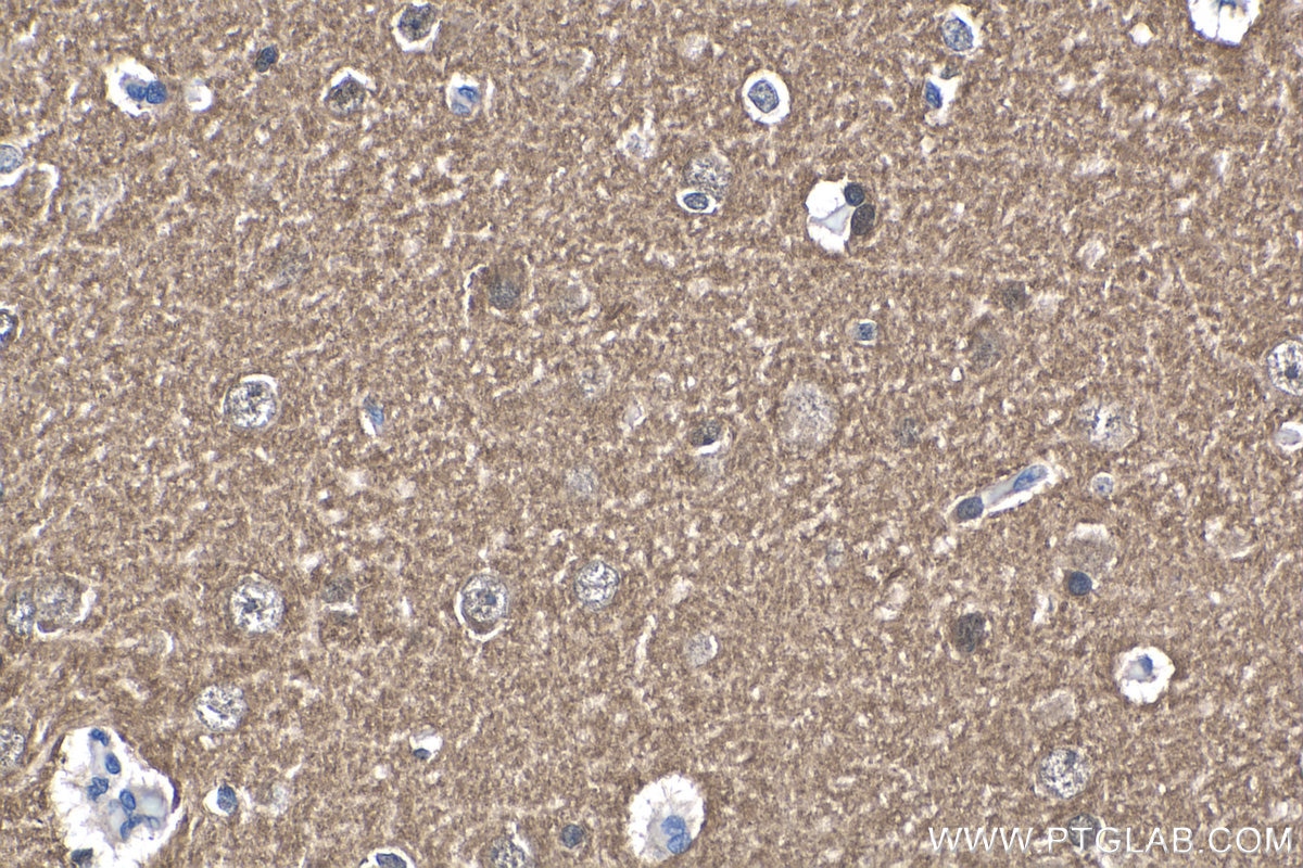 Immunohistochemistry (IHC) staining of human gliomas tissue using Alpha Synuclein Monoclonal antibody (66412-1-Ig)