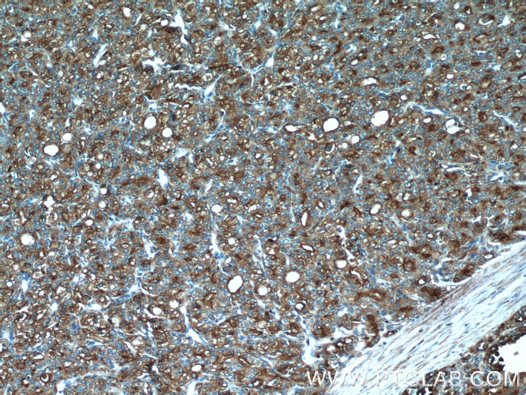 Immunohistochemistry (IHC) staining of human prostate cancer tissue using ACPP Polyclonal antibody (24410-1-AP)