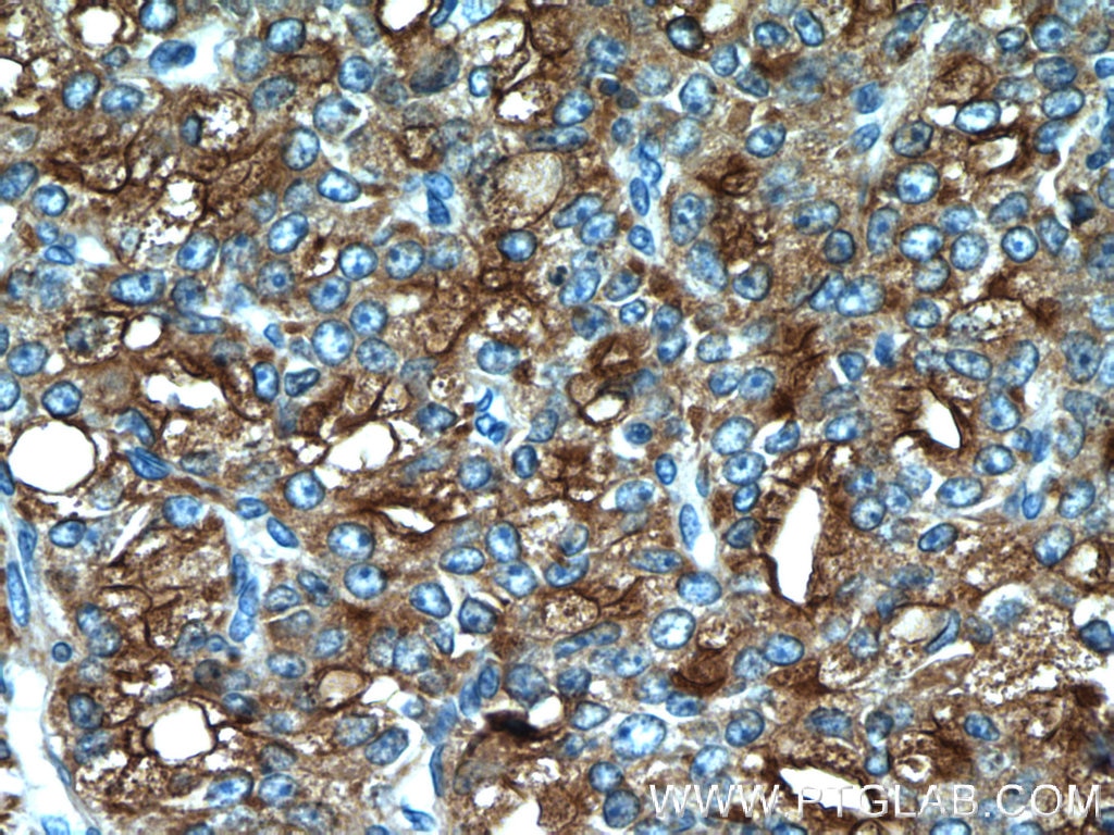 Immunohistochemistry (IHC) staining of human prostate cancer tissue using ACPP Polyclonal antibody (24410-1-AP)