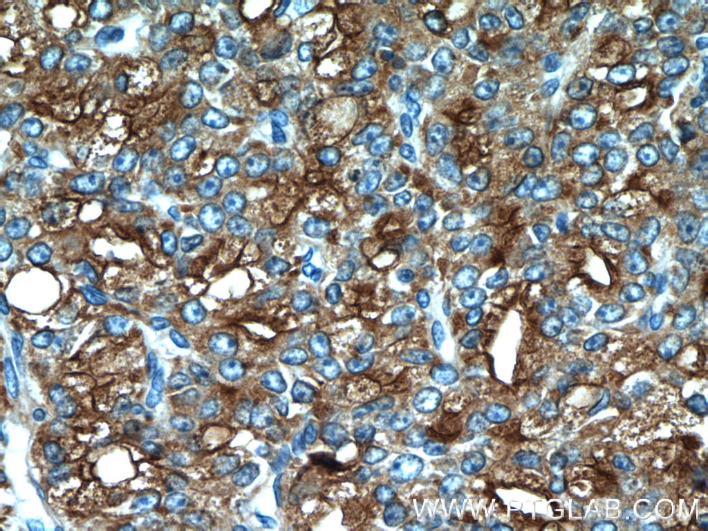 IHC staining of human prostate cancer using 24410-1-AP